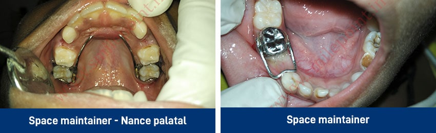 Child Care Dentistry